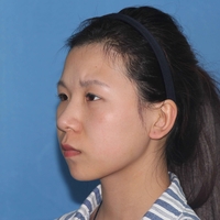 米亚整形眼部手术整形果如何?我也想拥有了自己的大眼睛!
