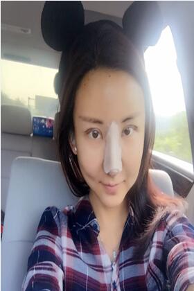 韩国隆鼻术果如何?真的比其他技术还厉害?