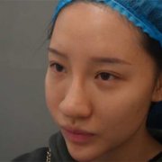 西安悦华整形做眼部整形果怎么样?能摆脱这眯眯眼吗? width=