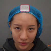 西安悦华整形做眼部整形果怎么样?能摆脱这眯眯眼吗?