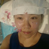 林洁瑜专家面部埋线提升技术真的那么强吗?真实案例走一波