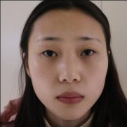 上海宏康整形医院切开双眼皮1天对比86天的恢复变化 width=
