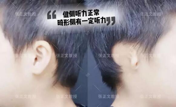 张正文教授“谈耳朵”：谈一谈耳畸形孩子的听力问题~