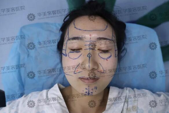 不用开刀，想要打造立体侧颜需要几步？