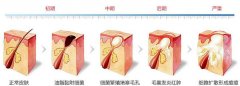 微针美容的大概费用是多少呢?影响的因素都有哪些? width=