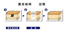 红宝石激光祛斑多少钱? width=