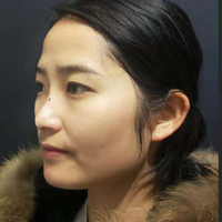 刘世铭院长实力如何?隆鼻+瘦脸案例分享