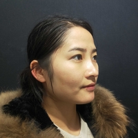 刘世铭院长实力如何?隆鼻+瘦脸案例分享