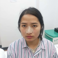 刘世铭院长实力如何?隆鼻+瘦脸案例分享