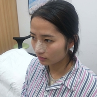 刘世铭院长实力如何?隆鼻+瘦脸案例分享