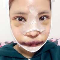 俞良钢下颌角整形技术如何?能改变我这脸型吗?