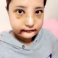 俞良钢下颌角整形技术如何?能改变我这脸型吗?