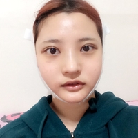 俞良钢下颌角整形技术如何?能改变我这脸型吗?
