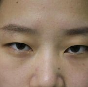 郭栋梁全切双眼皮+提肌前后对比皂片：一键拯救小眼睛 width=