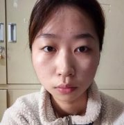 张冰洁开眼角术前术后对比：开眼角真的能让眼睛边长 width=