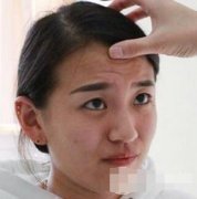 去除抬头纹的价钱：玻尿酸去抬头纹共6200元 width=