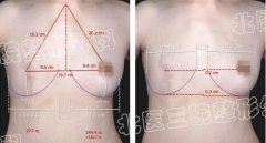 乳癌根治术后，她做了三维成像技术辅助下的乳房再造~ width=