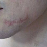 林伟亮祛疤果如何?能让我的肌肤毫无瑕疵吗? width=