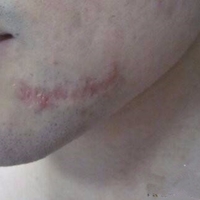 林伟亮祛疤果如何?能让我的肌肤毫无瑕疵吗?