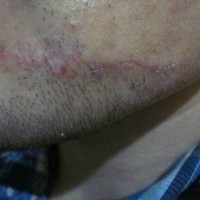 林伟亮祛疤果如何?能让我的肌肤毫无瑕疵吗?