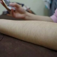 李常春医生激光脱毛技术如何?与毛茸茸的我说拜拜