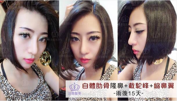 人工骨粉隆鼻+截驼峰+缩鼻翼，鼻形不再是梦想!!我的勇气大变身~ 