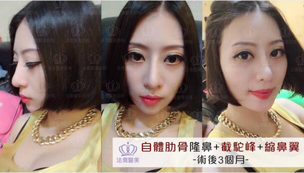 人工骨粉隆鼻+截驼峰+缩鼻翼，鼻形不再是梦想!!我的勇气大变身~ 
