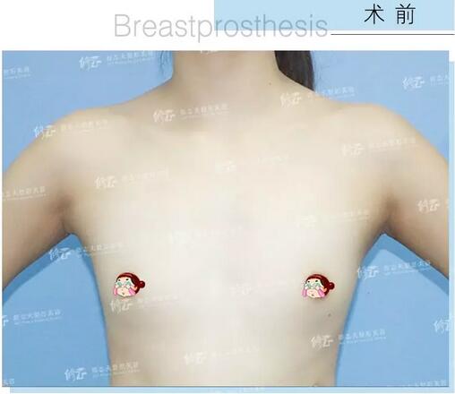 找厦门修志夫做了水滴型假体隆胸后，被赞“很有少女感”的美胸！
