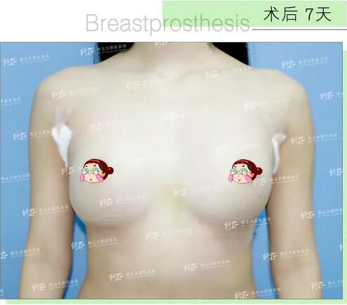 找厦门修志夫做了水滴型假体隆胸后，被赞“很有少女感”的美胸！