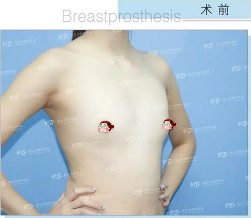 找厦门修志夫做了水滴型假体隆胸后，被赞“很有少女感”的美胸！