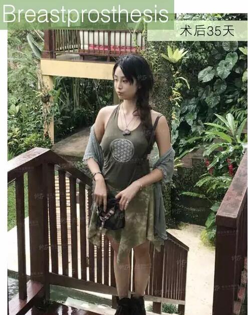 找厦门修志夫做了水滴型假体隆胸后，被赞“很有少女感”的美胸！