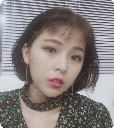 朱琳玻尿酸垫下巴+苹果肌真实案例分享，你喜欢吗？