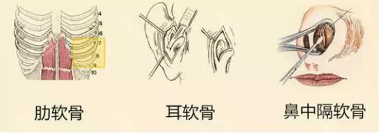 北京垫鼻子大概要多少钱?