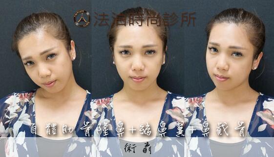 分段式假体隆鼻+鼻截骨+缩鼻翼之后啊，炒鸡既然如天生！