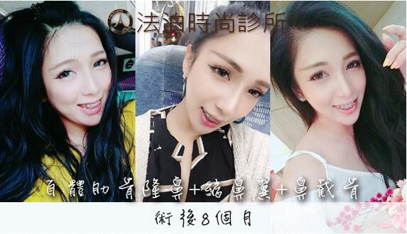分段式假体隆鼻+鼻截骨+缩鼻翼之后啊，炒鸡既然如天生！