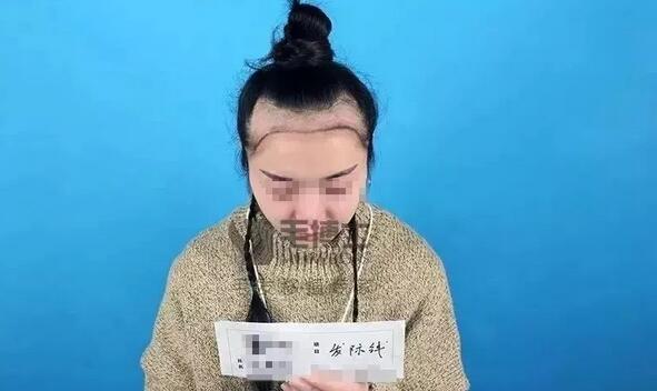 “内地胡杏儿”发际线后移，种植发际线，告别大额头！