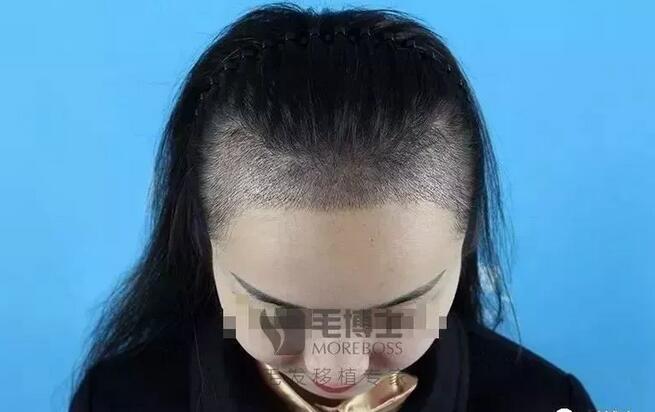 “内地胡杏儿”发际线后移，种植发际线，告别大额头！
