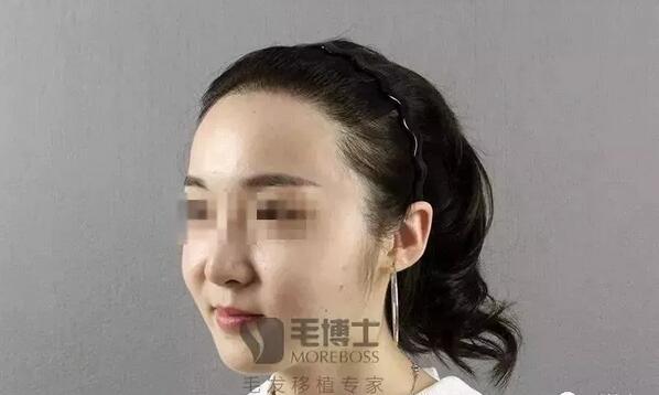 “内地胡杏儿”发际线后移，种植发际线，告别大额头！