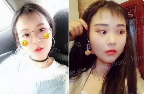下颌角接骨整形技术
