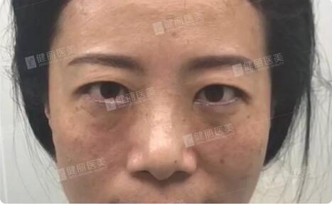 微创去眼袋＋眶隔脂肪转移术的案例这儿摆着一则，来围观哇！