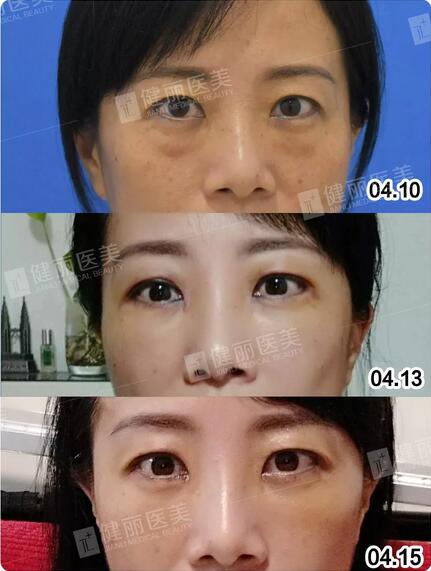 微创去眼袋＋眶隔脂肪转移术的案例这儿摆着一则，来围观哇！