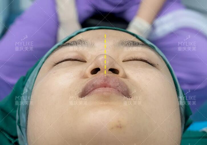 重庆美莱生态美鼻案例，歪鼻变仙女，这个鼻修复，满分！
