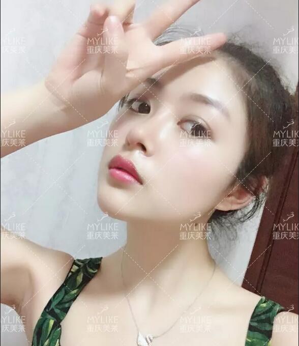 重庆美莱生态美鼻案例，歪鼻变仙女，这个鼻修复，满分！