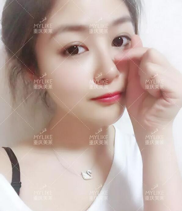 重庆美莱生态美鼻案例，歪鼻变仙女，这个鼻修复，满分！