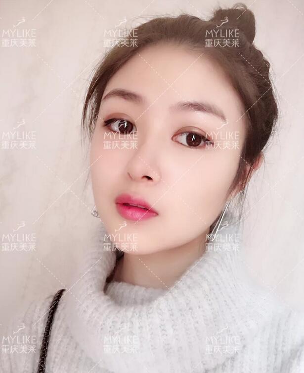 重庆美莱生态美鼻案例，歪鼻变仙女，这个鼻修复，满分！