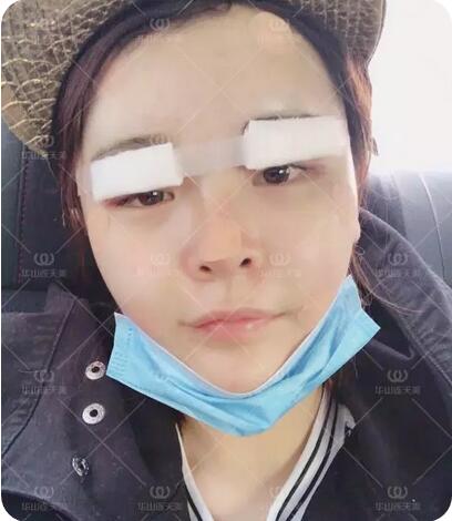 杭州华山连天美刘军自体脂肪填充额头和面颊+双眼皮案例记录~