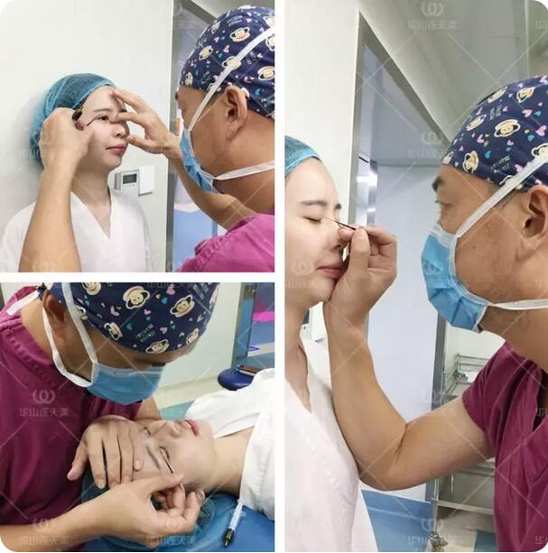 杭州华山连天美刘军自体脂肪填充额头和面颊+双眼皮案例记录~