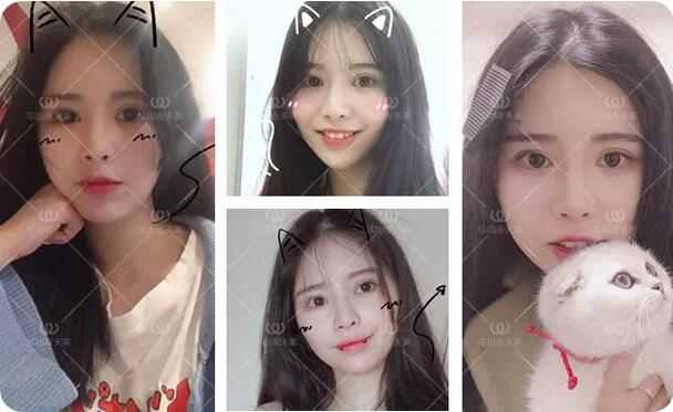 杭州华山连天美刘军自体脂肪填充额头和面颊+双眼皮案例记录~