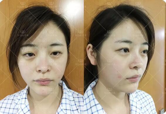 杭州华山连天美刘军自体脂肪填充额头和面颊+双眼皮案例记录~