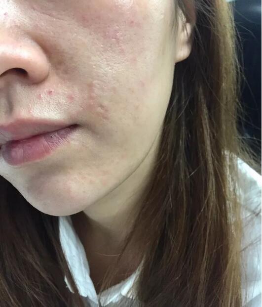 打完丽珠兰水光补水，30岁的她迎来了婴儿般逆天的肌肤！